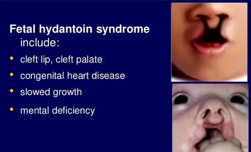 Fetal Hydantoin syndrome