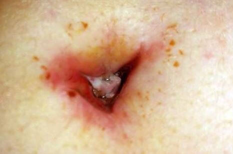 Infected Belly Button Piercing