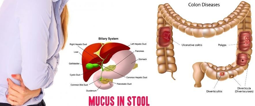 Mucus in stool causes symptoms images