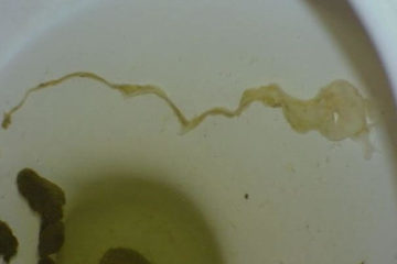 Mucus in stool picture
