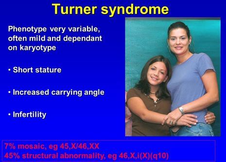 Turner Mosaic Syndrome Symptoms Signs