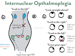 Internuclear ophthalmoplegia
