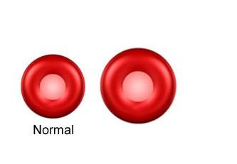 red blood cells normal and macrocytic