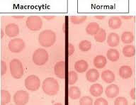 red blood cells normal and macrocytic