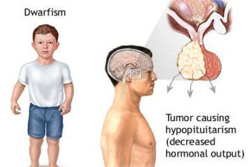 dwarfism pituitary tumors