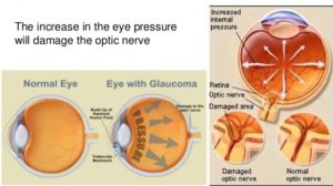 Glaucoma effects