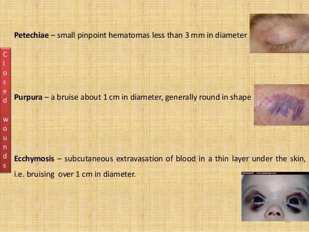 different types of hematomas