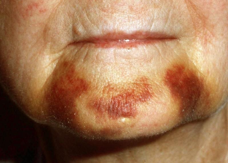 manifestation of ecchymosis on skin