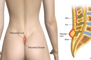 Pilonidal Cyst or Pilonidal Abscess Cyst on Tailbone