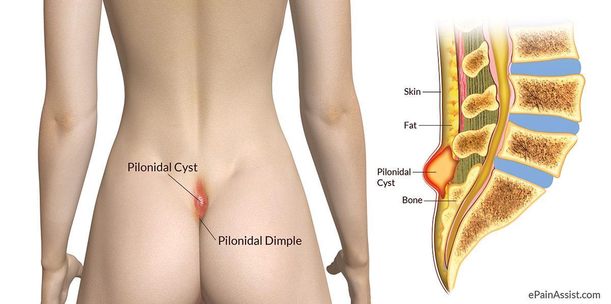 Cyst on Tailbone or Pilonidal Abscess