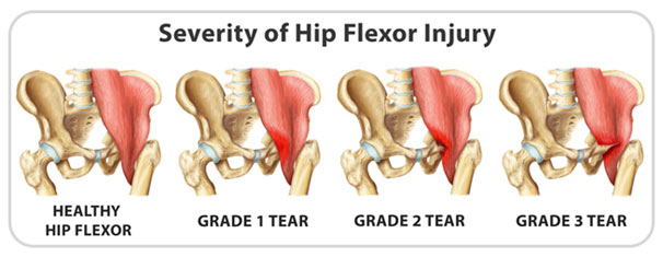 hip flexor strain injury