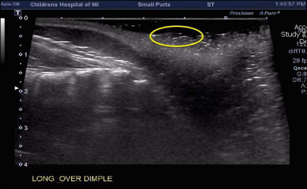Ultrasound shows no spinal dysraphism