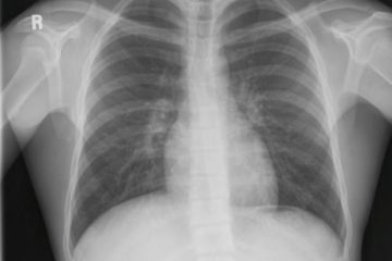 Bibasilar Atelectasis of lungs