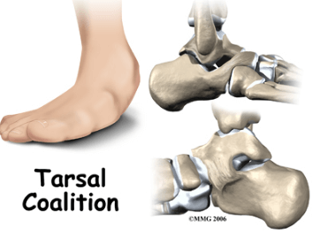 Tarsal Coalition (foot)