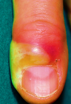 Paronychia on finger