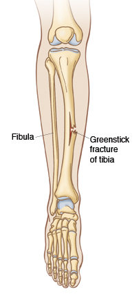 Greenstick Fracture of leg