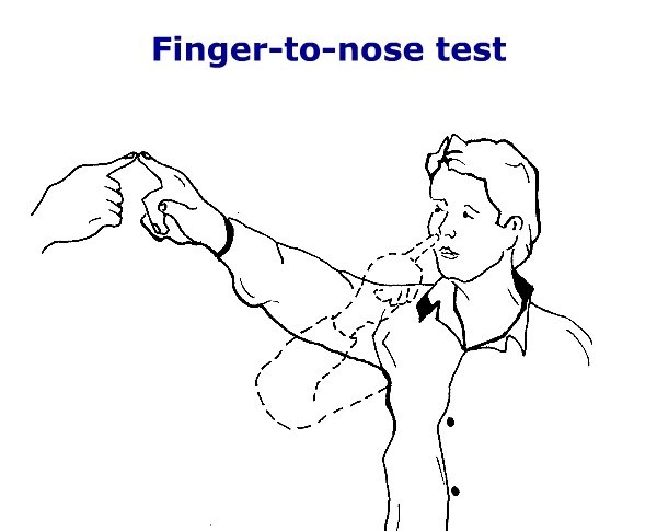 Dysmetria -  finger to nose test
