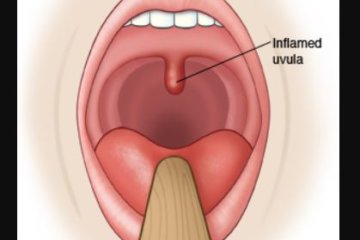 Inflamed uvula or uvulitis symptoms or swollen uvula
