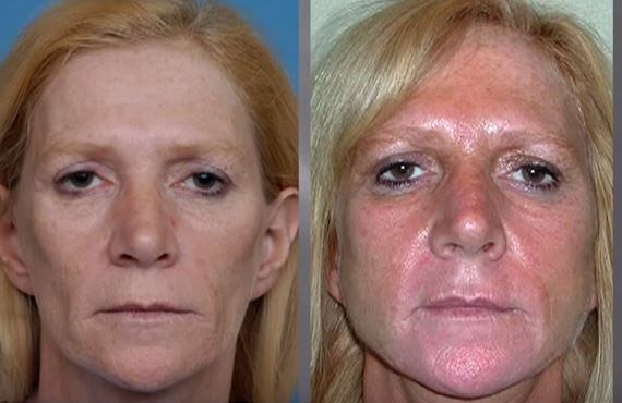 Lipoatrophy before and after treatment